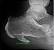 Image result for icd 10 code for right calcaneal enthesophyte