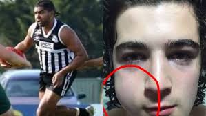 Parolee sentenced over jaw-breaking punch, but will the decision echo  outside country footy?