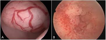 However, the early signs and symptoms of uterine cancer may vary from person to person. Hysteroscopic Endometrial Focal Resection Followed By Levonorgestrel Intrauterine Device Insertion As A Fertility Sparing Treatment Of Atypical Endometrial Hyperplasia And Early Endometrial Cancer A Retrospective Study Journal Of Minimally Invasive