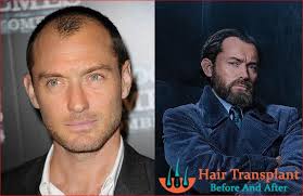 Pin On Hair Loss In Men