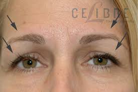 You can easily determine whether a celebrity has botox or not. Before And After Botox Brow Lift 3