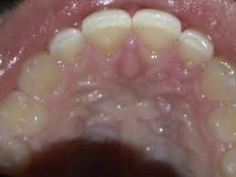 Image result for Periodontal Abscess