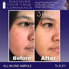 Karena ternyata kulit berminyak dapat kita atasi secara alami, dan mudah dilakukan di rumah. Jual Atasi Kulit Wajah Kering Kusam Keriput Bekas Jerawat Trulum 15ml Jakarta Timur Skincare Alami Tokopedia