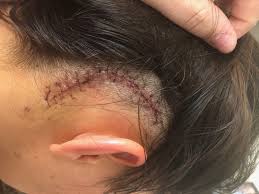 Pin On Meningioma Info