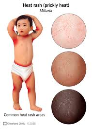 Image result for sweat rash on back