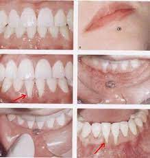 Dentaltown Removing A Lip Piercing Lip Piercings Can Cause Gingival Recession Lip Piercing Dental Hygiene School Dental Hygiene Dentistry