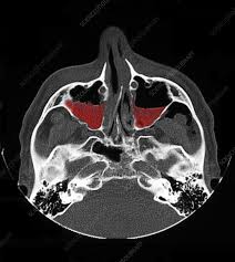 Image result for Sinus CT