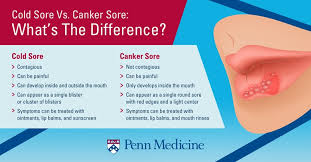 What to do to treat throat ulcers faster Cold Sores Vs Canker Sores What Are They And How Do I Get Rid Of Em Penn Medicine