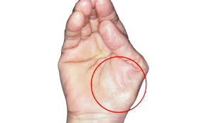 Rasa Sakit Di Tapak Tangan Mungkinkah Anda Penghidap Sindrom Carpal Tunnel