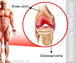 Osteosarcoma is the most common malignant bone tumor (if one excludes myeloma). Predisposing Factors Of Osteosarcoma