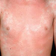 Causes And Cures Of Rashes Parents