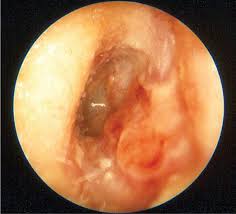 Image result for Acute Otitis Externa
