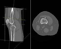 CT scan of the right knee showing the endobutton in suprapatellar pouch...  | Download Scientific Diagram