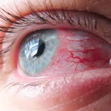 Red eyes occur when the small blood vessels that are present on the surface of the eye become these tiny blood vessels can become dilated (causing bloodshot eyes) due to a number of different. Red Eyes Specialist Colts Neck Nj John Ghobrial Md Board Certified Ophthalmologist Eye Associates Of Monmouth