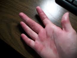 54,000+ vectors, stock photos & psd files. Identifying 21 Common Red Spots On Skin Universal Dermatology