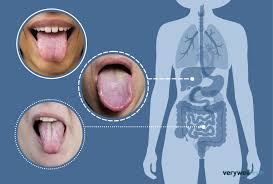 Image result for yellow tongue infection
