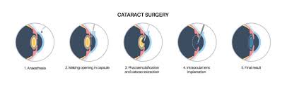 Image result for Cataract Extraction