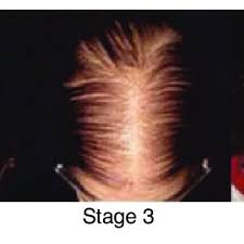 2nd stage of hair loss. Sinclair Scale For Female Pattern Hair Loss Stage 1 Is Normal Stage 2 Download Scientific Diagram
