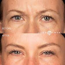 After you've had two or three treatments, however, you may only need to have top up injections once every three to six months. Jeuveau Injections Jason Emer Md