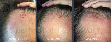 Alexiades notes that a recent aad study showed that microneeedling alone can only give temporary results that do not last. Microneedling For Hair Loss What S The Best Needle Length It Depends