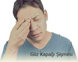Goz Kapagi Sismesi Nedenleri Ve Tedavi Yontemleri Gozler