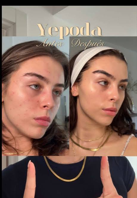 Mi antes y después real con @Yepoda #yepoda #kbeauty #skincareroutine #koreanskincare