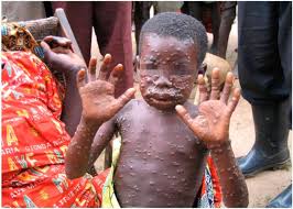 What are causes & symptoms of monkeypox disease. All You Need To Know About Monkeypox Virus