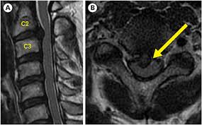 When you use our links to buy products, we may earn a commission but that in no. Posterior Approach In C2 3 Disc Herniation C1 Laminectomy C2 3 Laminoplasty And Posterior Fixation In C2 3 Disc Herniation