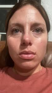 Lip flip &/or filler recommendations?