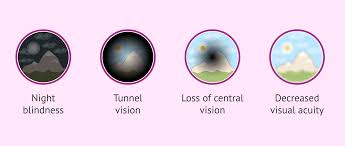 Image result for Decreased Visual Acuity