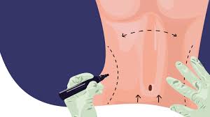 Hey everyone, welcome back to another dear diary! Tummy Tuck Surgery What To Expect From Cost To Recovery Time Allure