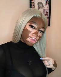 Nữ người mẫu có làn da bạch biến đặc biệt