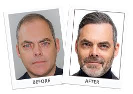 His passion for the creative side of medicine has led him to carve a niche in the field of beauty in crafting the most natural look to augment and contour. Alvi Armani Artistic Hair Transplants Beverly Hills Los Angeles Fue Hair Restoration