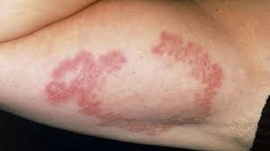 This study focused on women and children with type 1 diabetes. Type 2 Diabetes And Skin Pictures Dermopathy Infections And More