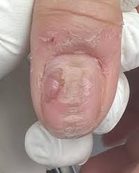 Image result for Onychotillomania feet
