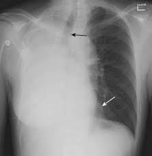 Image result for Atelectasis