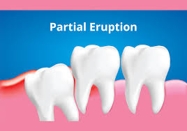 An abscessed tooth is an infection affecting the root of a tooth or that which is located between the tooth and the gum. Wisdom Tooth Extraction Adelaide Dental Centre Personal Dental Care