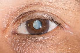 For specific medical questions, please consult your doctor. Have Sleep Problems You May Have A Cataract Here S Why