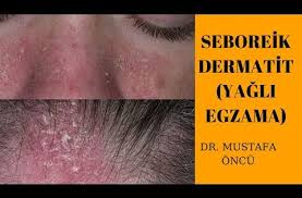 12 Soruda Seboreik Dermatit Yagli Egzama Youtube 2021 Youtube Sac Dokulmesi Videolar
