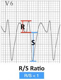 Vt Versus Svt Litfl Medical Blog Ecg Library Basics Medical Mnemonics Medical Knowledge Cardiac Sonography