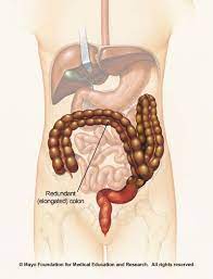 Live Happy Redundant Colon