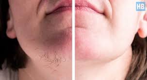 Kent childs answered 29 years experience obstetrics and gynecology burn: Top 7 Best Facial Hair Removal Creams For Sensitive Skin Harlotbeauty