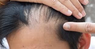 Successfully treated more than 8000 patients across globe in delhi,india. Stem Cell Therapy For Hair Loss Biotech Cosmetic Surgery Laser Center