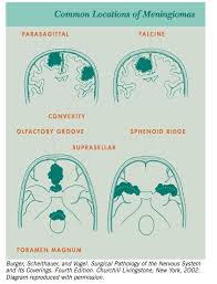 Pin On Brain Tumor Awareness