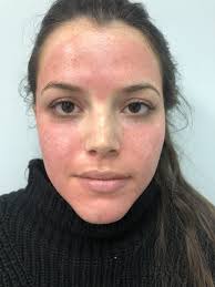 What is PRF and what can it treat?