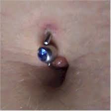 Piercing Rejection Belly Button Piercing Navel Piercing Keloid