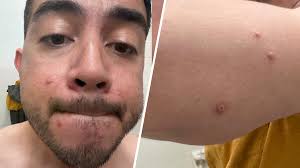 Paciente con viruela del mono viaja a Los Ángeles porque en San Diego los  recursos son escasos