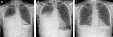 Detection of pleural effusion(s) and the creation of an initial differential diagnosis are highly the imaging of pleural effusions will be presented here. The Management Of Benign Non Infective Pleural Effusions European Respiratory Society
