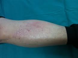 Check spelling or type a new query. The Skin And Viral Liver Disease Intechopen