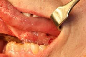 Image result for papillomavirus tongue)